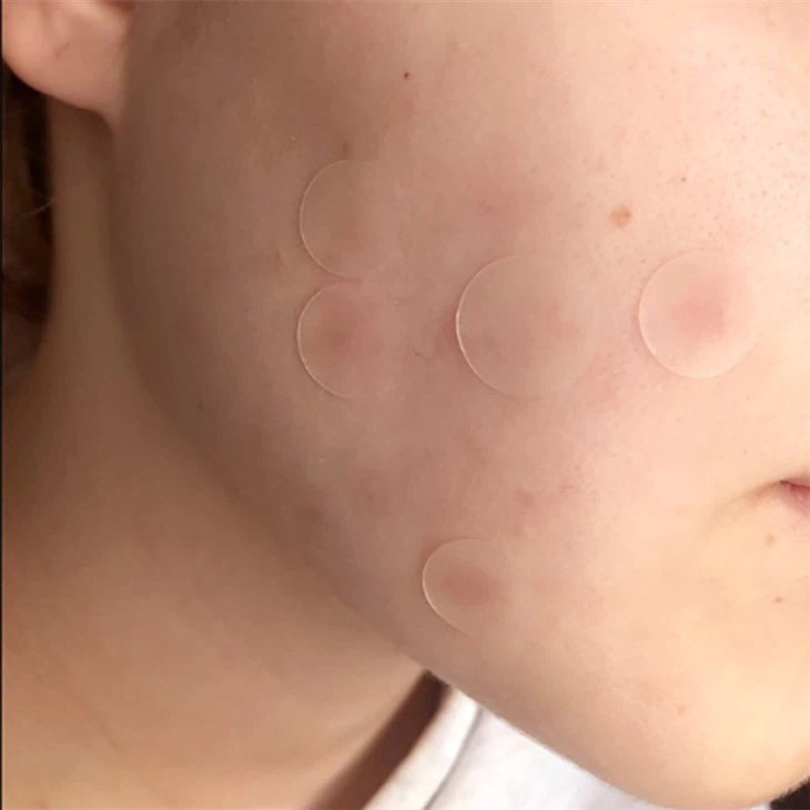 Hydrocolloid Clears Acne Patch